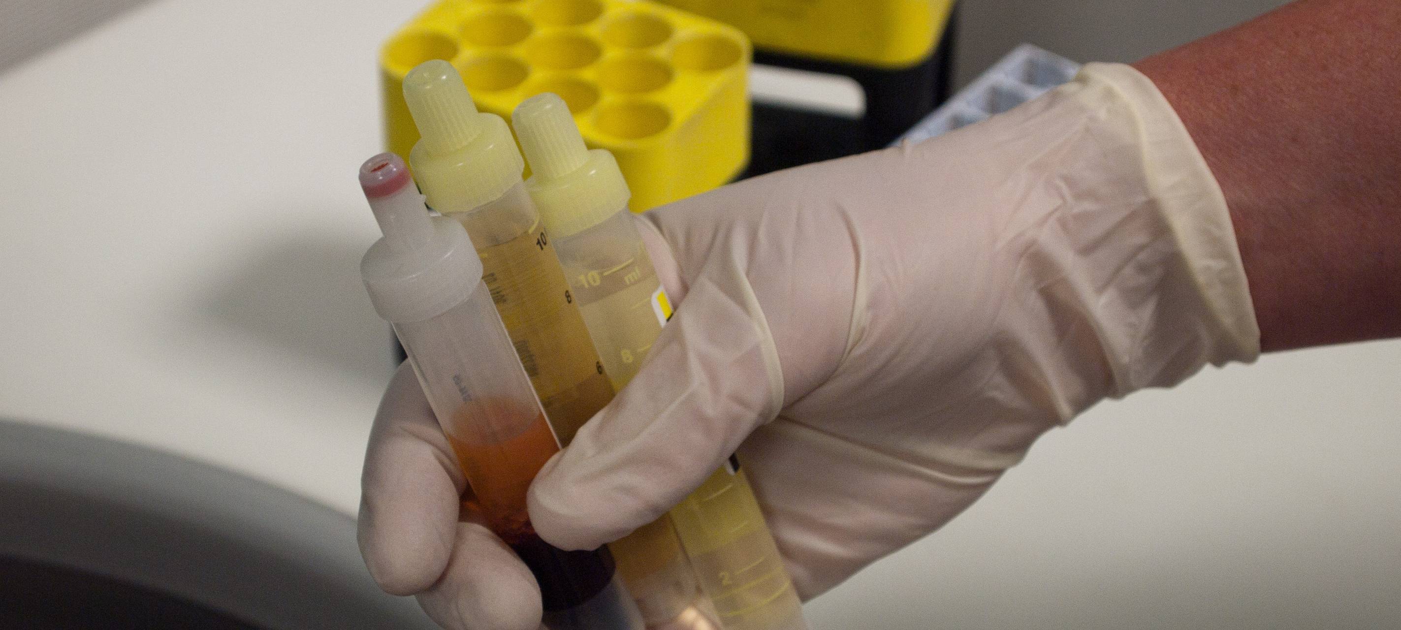 Erste bekannte Fälle in Deutschland: Die wichtigsten Infos zum Affenpockenvirus