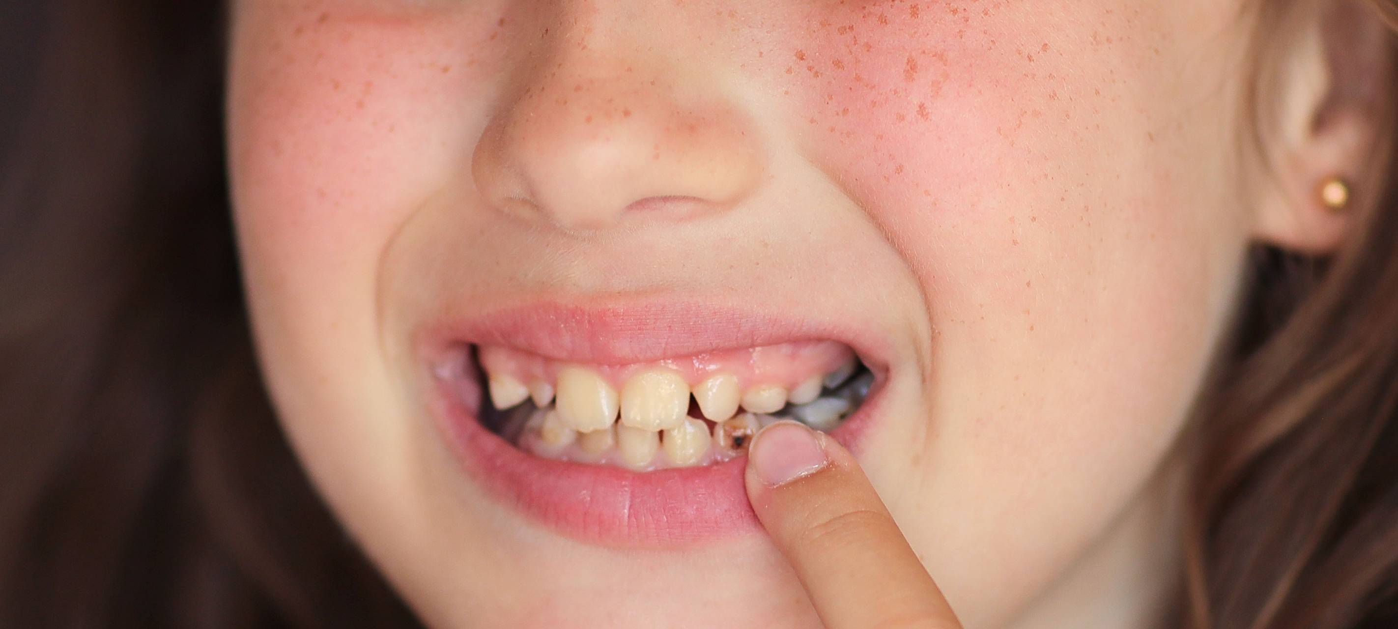 Immer mehr Schulanfänger bei uns mit Kariesproblemen